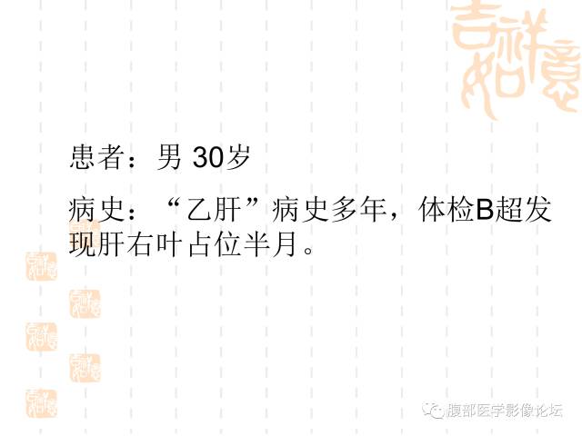 【病例】肝右叶局灶性结节性增生1例CT及MR影像表现