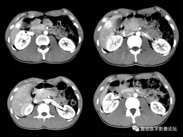 【病例】肝右叶局灶性结节性增生1例CT及MR影像表现