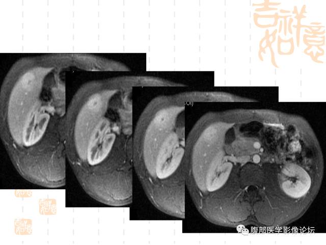 【病例】肝右叶局灶性结节性增生1例CT及MR影像表现