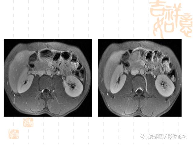 【病例】肝右叶局灶性结节性增生1例CT及MR影像表现