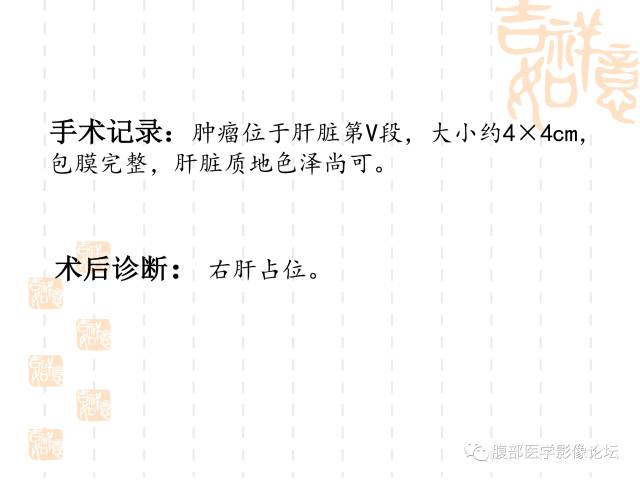 【病例】肝右叶局灶性结节性增生1例CT及MR影像表现