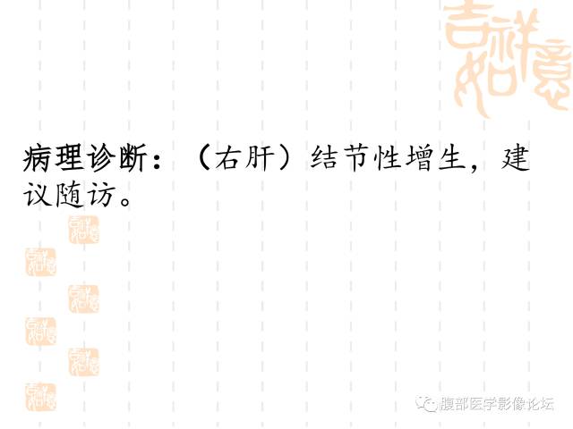 【病例】肝右叶局灶性结节性增生1例CT及MR影像表现