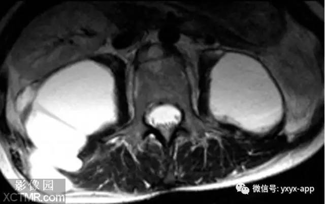 【病例】脊柱结核1例MR影像诊断分析 【病例】脊柱结核1例MR影像诊断分析