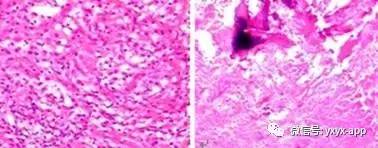 【病例】脊柱结核1例MR影像诊断分析 【病例】脊柱结核1例MR影像诊断分析