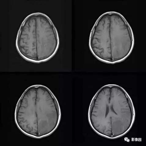 【病例】中枢神经系统淋巴瘤1例MR影像表现 【病例】中枢神经系统淋巴瘤1例MR影像表现