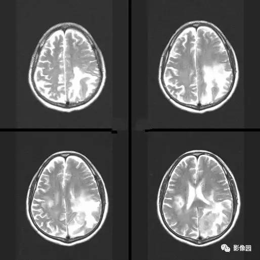 【病例】中枢神经系统淋巴瘤1例MR影像表现 【病例】中枢神经系统淋巴瘤1例MR影像表现