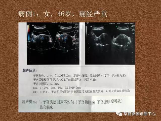 【PPT】子宫腺肌病