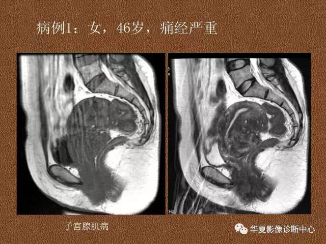 【PPT】子宫腺肌病