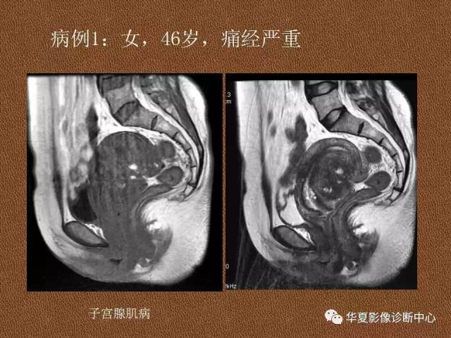 【PPT】子宫腺肌病