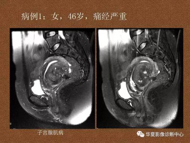 【PPT】子宫腺肌病