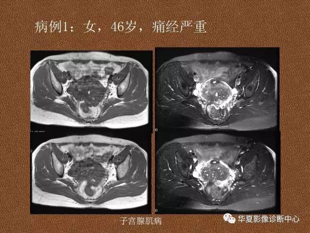 【PPT】子宫腺肌病