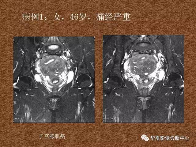 【PPT】子宫腺肌病