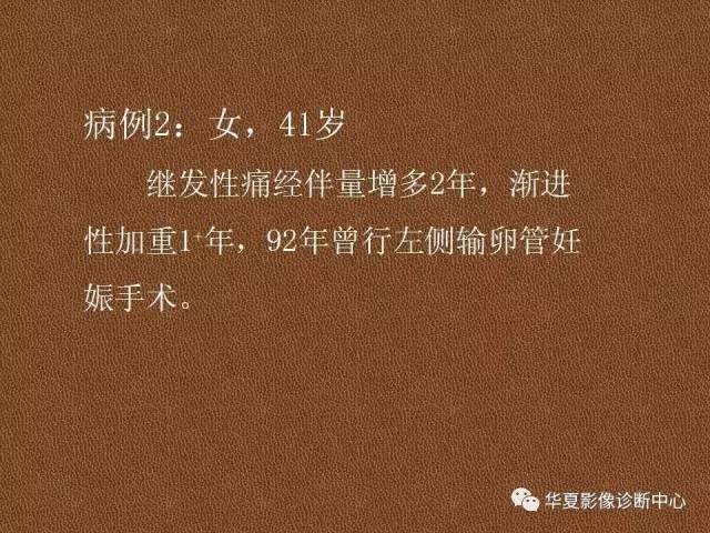 【PPT】子宫腺肌病