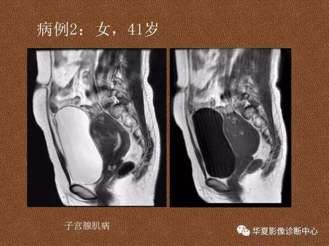 【PPT】子宫腺肌病