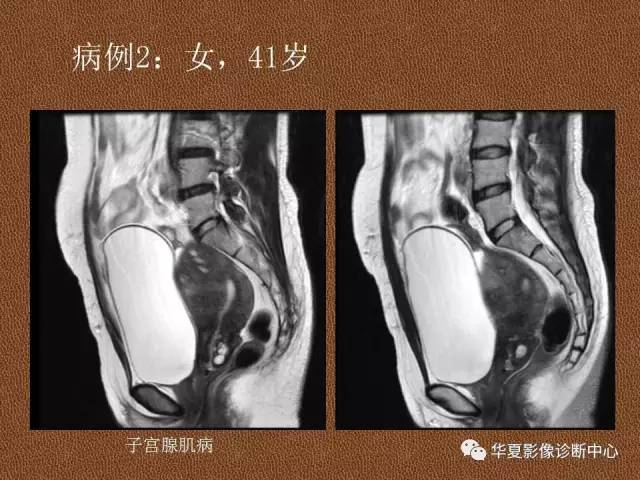 【PPT】子宫腺肌病