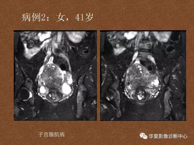 【PPT】子宫腺肌病