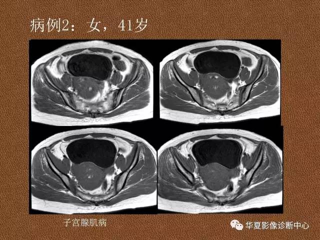 【PPT】子宫腺肌病