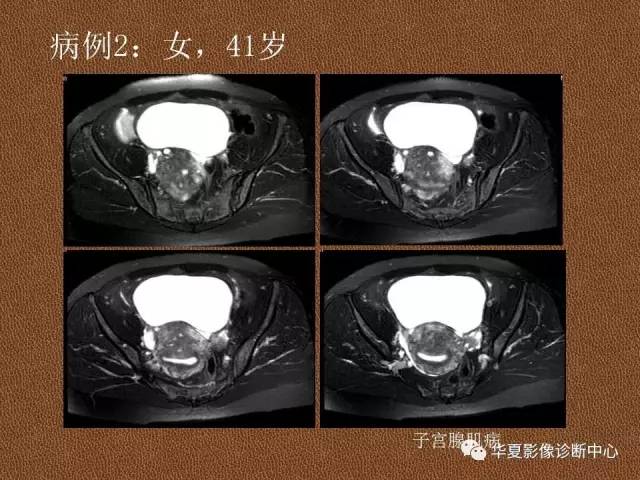 【PPT】子宫腺肌病