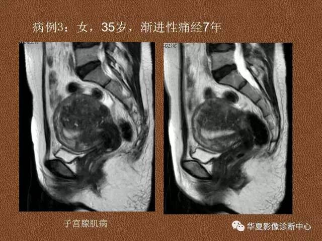 【PPT】子宫腺肌病