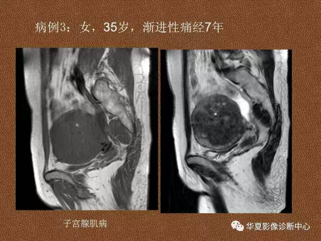 【PPT】子宫腺肌病