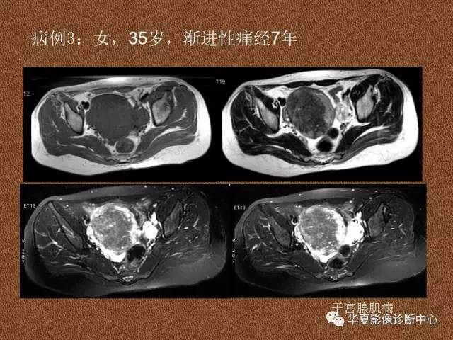 【PPT】子宫腺肌病