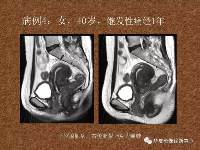 【PPT】子宫腺肌病