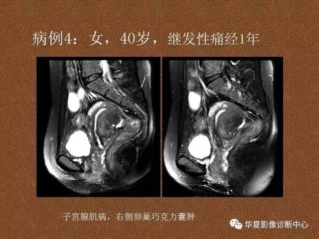 【PPT】子宫腺肌病