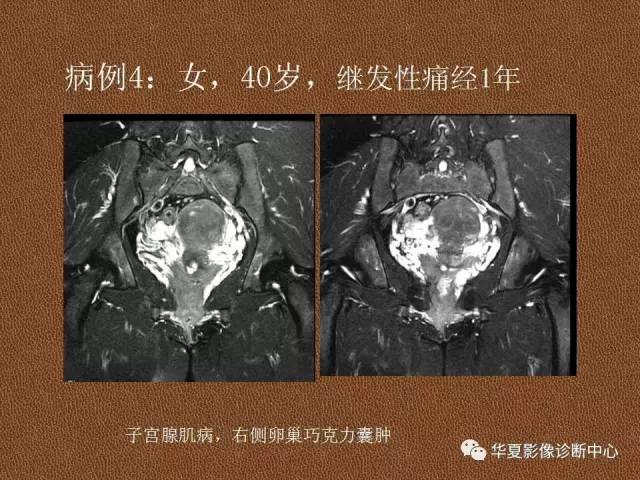 【PPT】子宫腺肌病