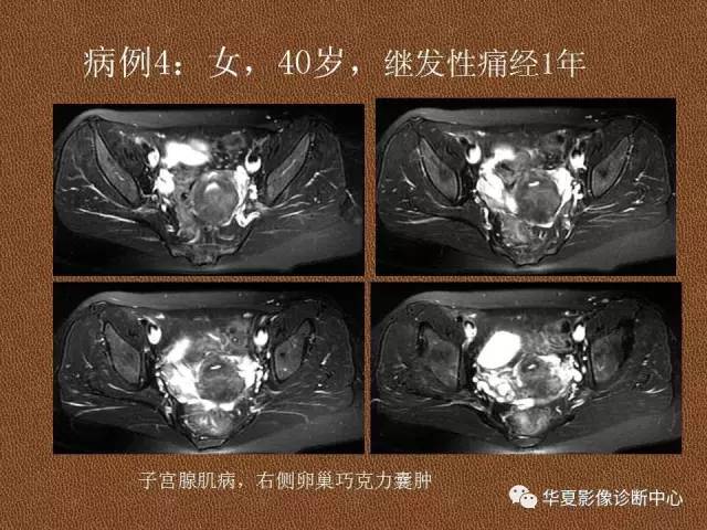 【PPT】子宫腺肌病