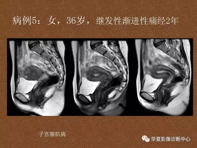 【PPT】子宫腺肌病