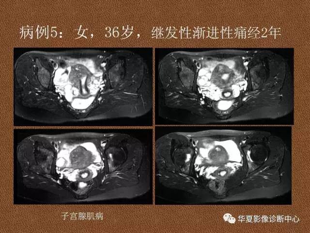 【PPT】子宫腺肌病