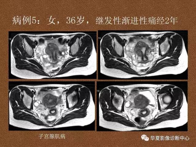 【PPT】子宫腺肌病