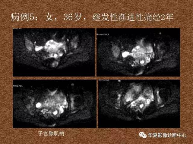 【PPT】子宫腺肌病