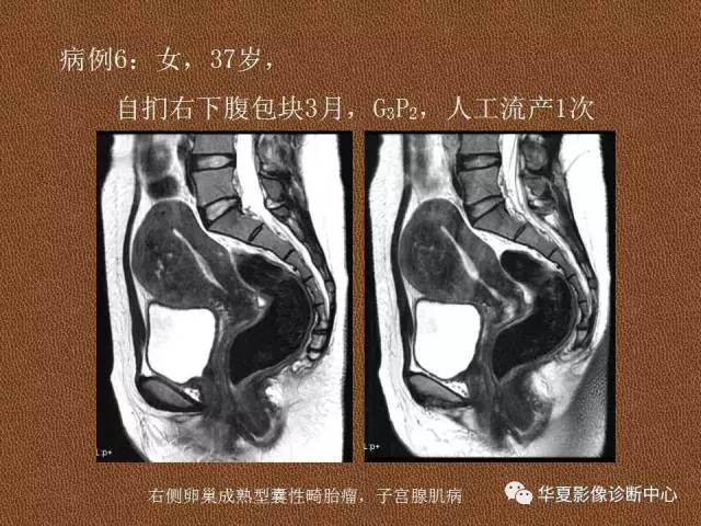 【PPT】子宫腺肌病