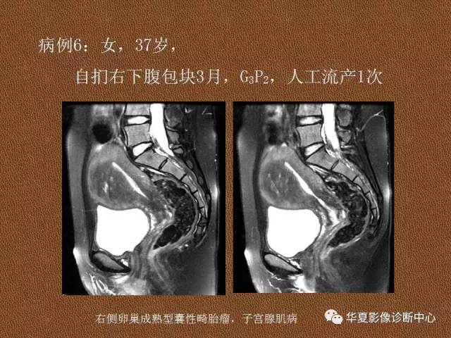 【PPT】子宫腺肌病