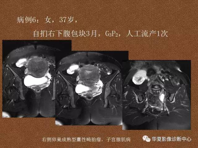 【PPT】子宫腺肌病