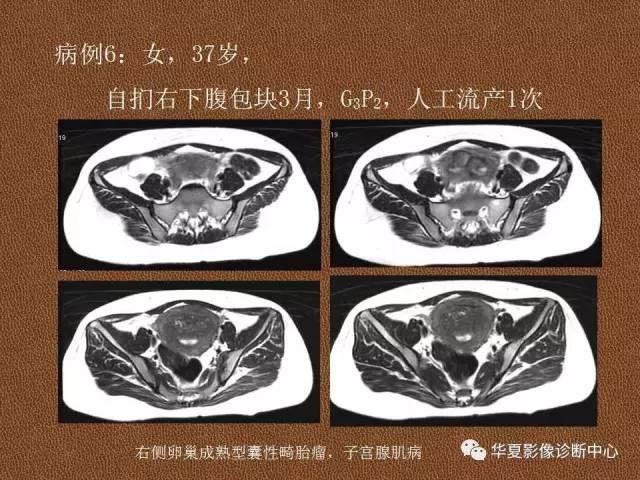 【PPT】子宫腺肌病