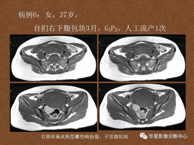 【PPT】子宫腺肌病
