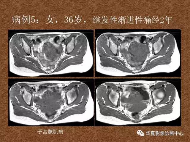 【PPT】子宫腺肌病