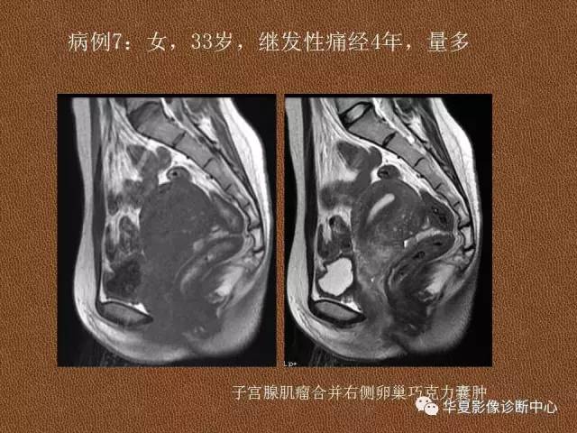 【PPT】子宫腺肌病