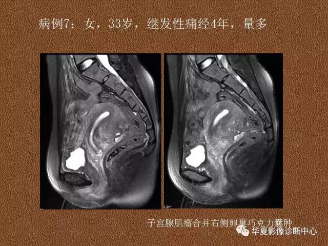【PPT】子宫腺肌病
