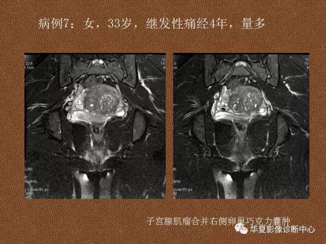【PPT】子宫腺肌病