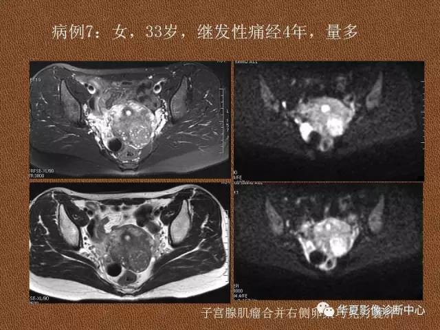 【PPT】子宫腺肌病