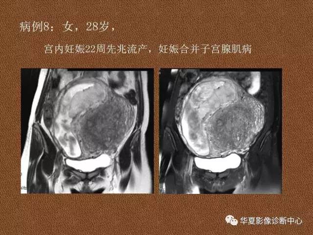 【PPT】子宫腺肌病
