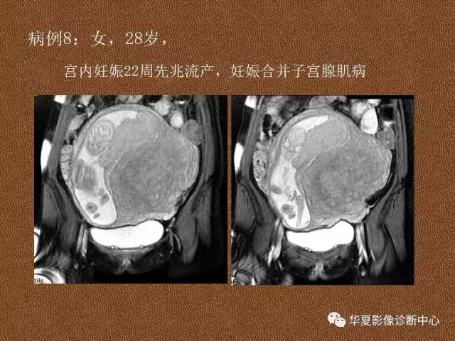 【PPT】子宫腺肌病