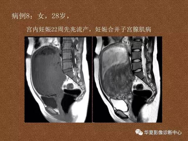 【PPT】子宫腺肌病