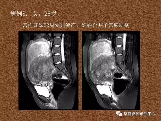 【PPT】子宫腺肌病
