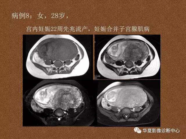 【PPT】子宫腺肌病