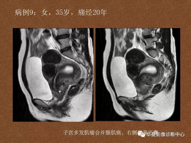【PPT】子宫腺肌病
