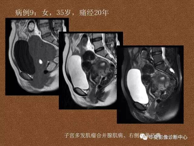 【PPT】子宫腺肌病